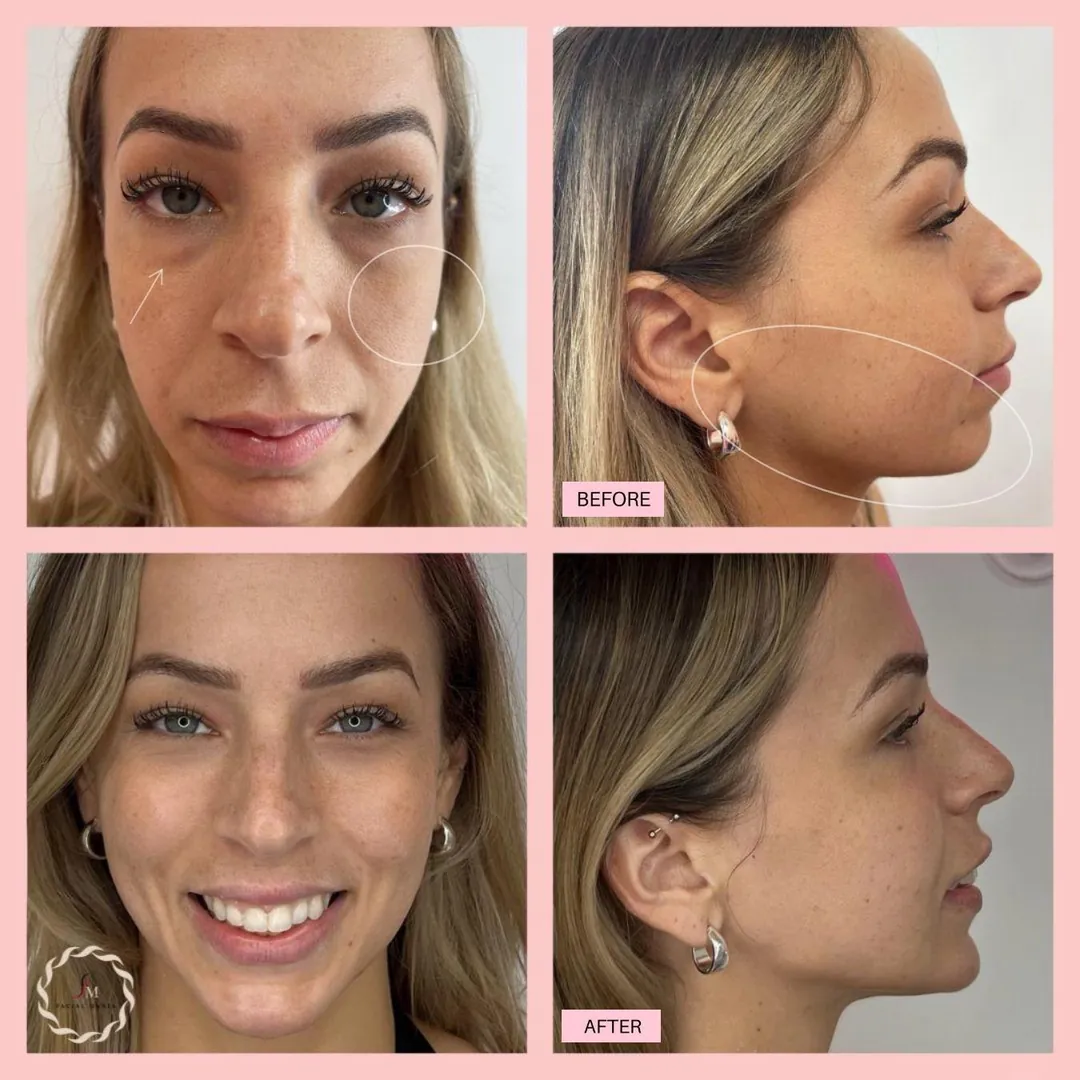 Facial Mania before and after facial treatment results
