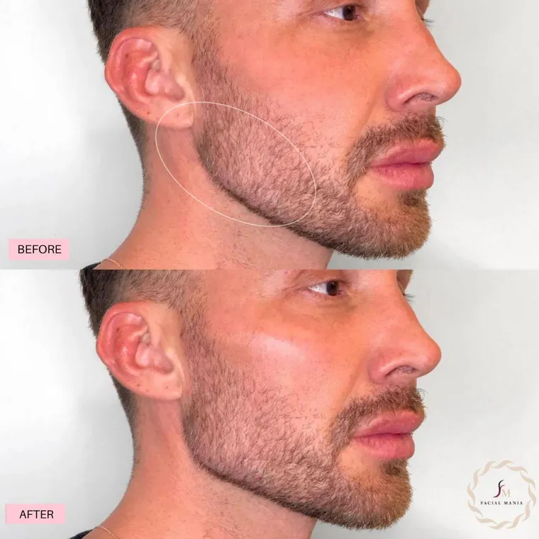 Facial Mania treatment result 1