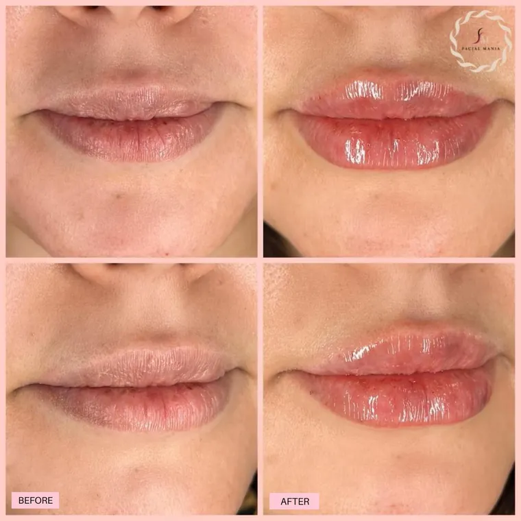 Facial Mania treatment result 2