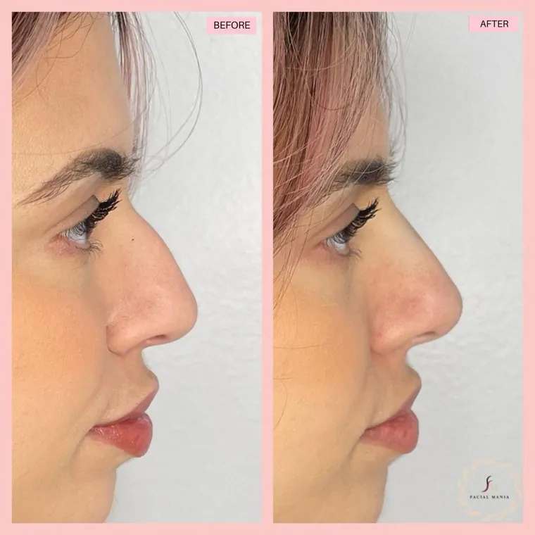 Facial Mania treatment result 3