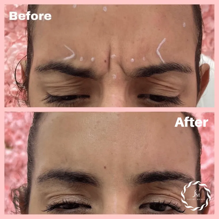 Facial Mania treatment result 4