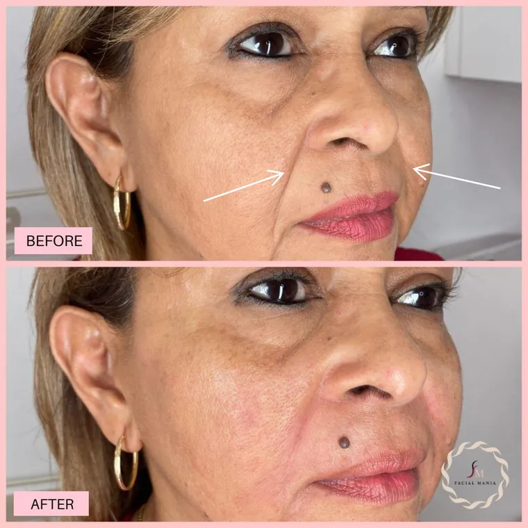 Facial Mania treatment result 7