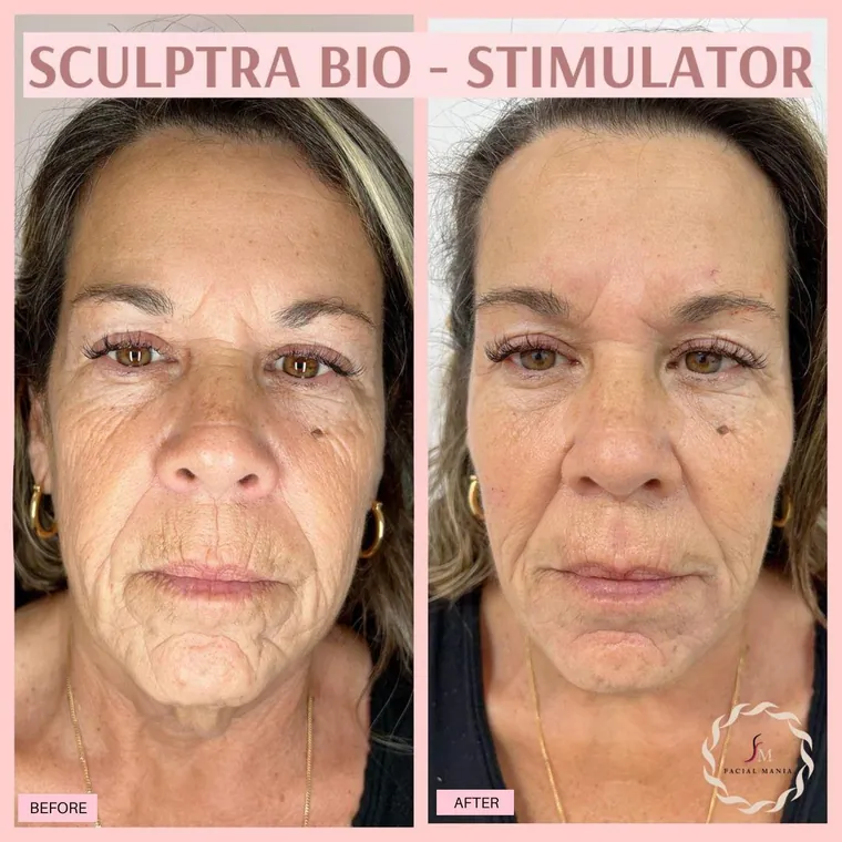 Facial Mania treatment result 8