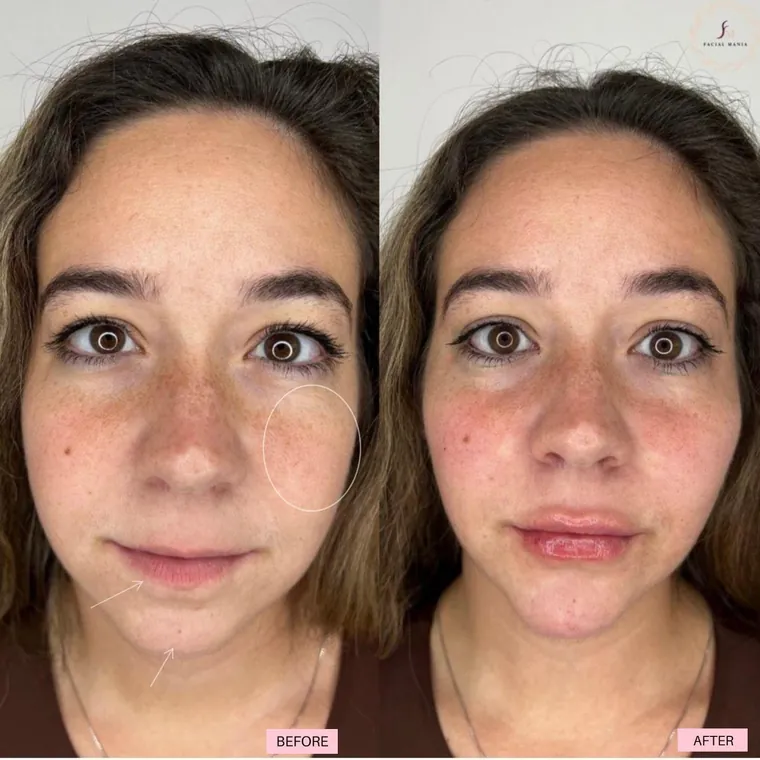 Facial Mania treatment result 9