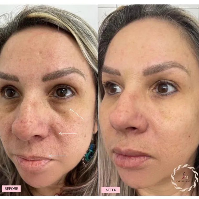 Facial Mania treatment result 10