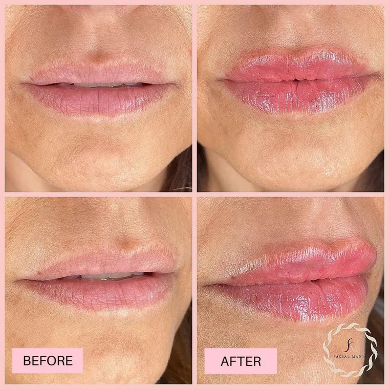 Facial Mania treatment result 11