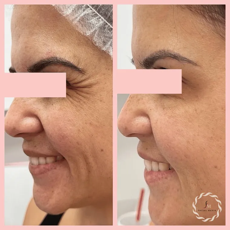 Facial Mania treatment result 12