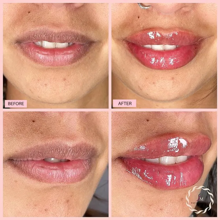 Facial Mania treatment result 13