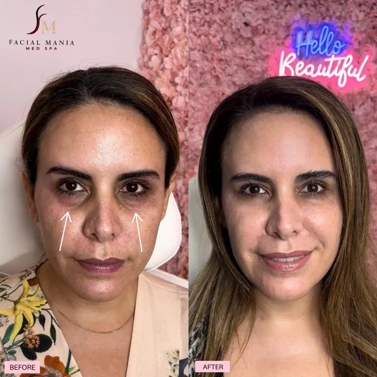 Facial Mania treatment result 14
