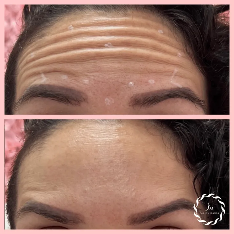 Facial Mania treatment result 15
